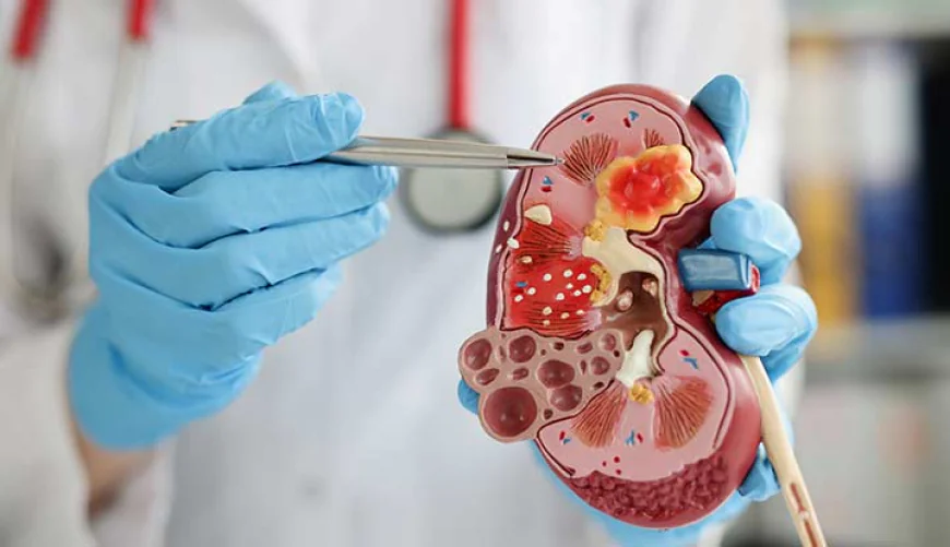 Everything You Should Know About Kidney Stones Treatment