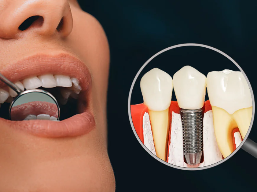 Why Choosing the Right Implantologist Matters