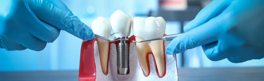 Best Dental Implant Specialist: What Patients Should Look For