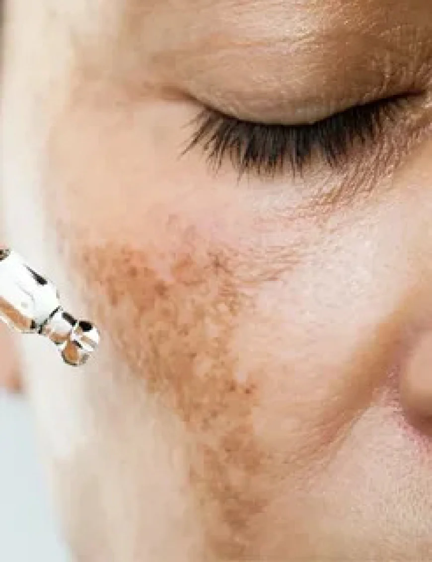 Skin Pigmentation in Islamabad – Effective Treatments for Clear and Youthful Skin