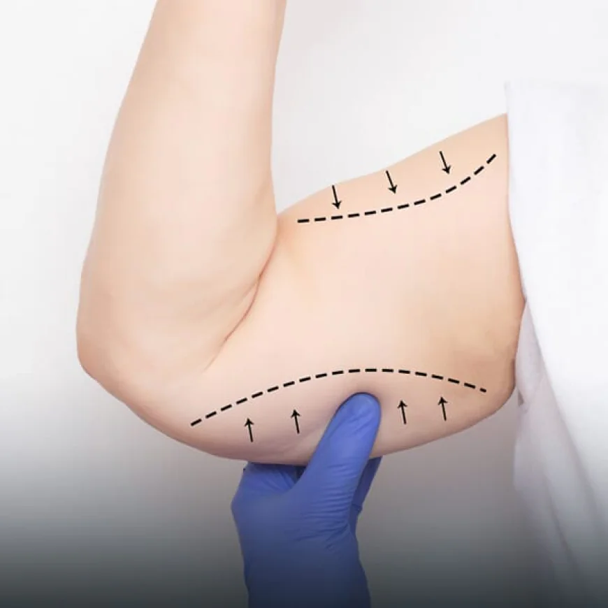 Who Is an Ideal Candidate for Arm Lift Surgery?