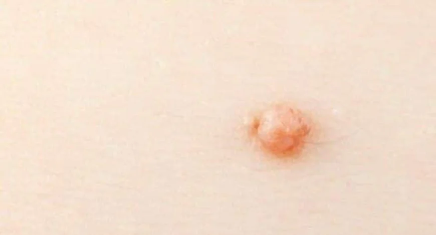 How Long Does It Take to Recover After Genital Wart Removal London?