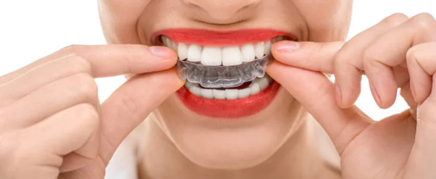 Top Advantages of Choosing Invisible Braces