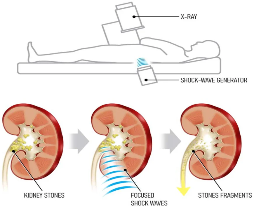 Kidney Stone Relief: Understanding Lithotripsy Treatment