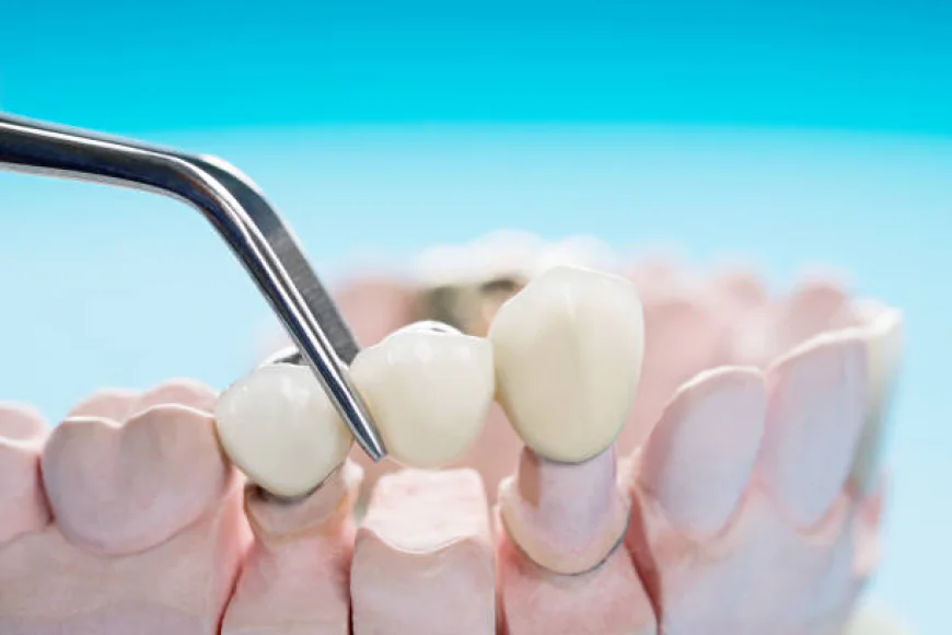 What Makes Dental Bridges a Popular Tooth Replacement Option?