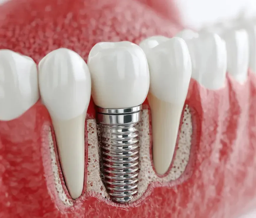 Same-Day Tooth Replacement: Is It Safe and Effective?