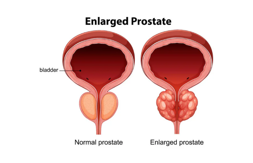 Prostate Enlargement Treatment in Gurgaon
