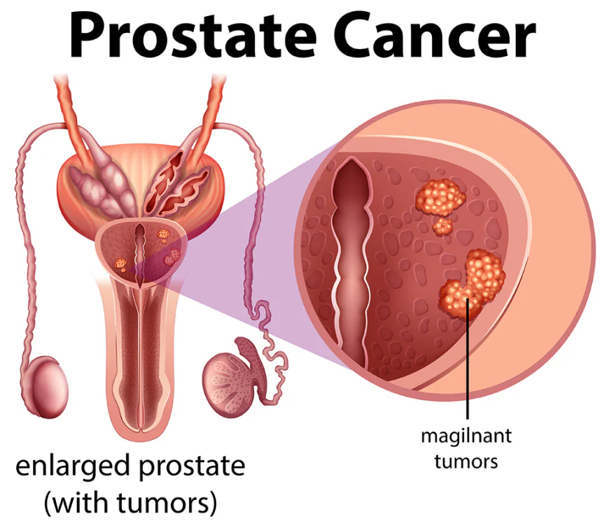Prostate Cancer Treatment in Gurgaon