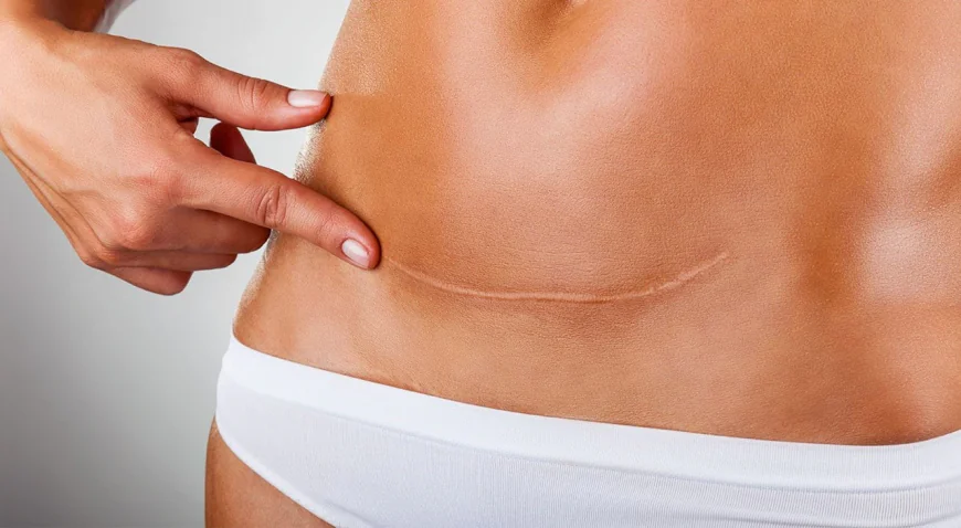 Why Is Mini Abdominoplasty Trending?