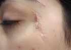 Can Facial Scar Revision Improve Burn Scars?