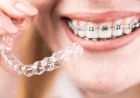 Orthodontic Treatment: Procedure, Benefits & What Patients Should Know