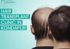 Why More People in Hyderabad Are Choosing Hair Transplant in Kondapur