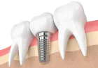 Before Comparing Dental Implant Quotes, Read This