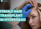 Hair Loss in Women and the Rise of FUE: What Every Patient Should Know