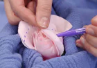 How body anatomy influences labiaplasty decisions