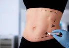 What Factors Affect the Success of a Tummy Tuck