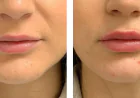 Professional Lip Enlargement in Riyadh | Book Today