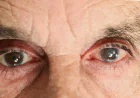 What Are the 8 Signs of Glaucoma?
