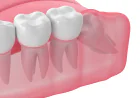 Why Delaying Tooth Removal Can Affect Your Oral Health