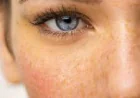 Best Benefits of Skin Pigmentation Treatment in Dubai