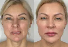 How Does Sculptra Restore Youthful-Looking Skin at Glamorous Clinic ?