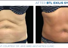Skin Tightening Treatments for Firmer and Younger-Looking Skin