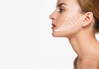 Does a Thread Lift Assist in Reducing Wrinkles?