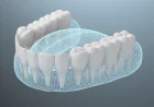 The Role of Full Mouth Restoration in Restoring Function and Confidence