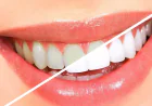Teeth Cleaning in Dubai for a Healthier and Brighter Smile