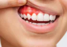 Why Are My Gums Bleeding When I Brush? | Bryn Mawr