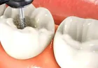 Root Canal Treatment With Inflammation in Dubai | Save Your Natural Tooth