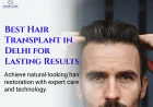 Why More People in Delhi Are Choosing Hair Transplant Surgery Over Other Treatments