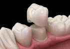Teeth Whitening Service in Bikaner: Brighten Your Smile with Professional Dental Care
