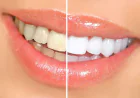 Porcelain Veneers Thousand Oaks: Expert Cosmetic Dentistry Near You
