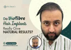 Do Biofibre Hair Implants Really Give Natural Results?