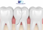 Cracked Tooth Emergency? What To Do | Dentist Bryn Mawr
