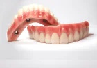 How Long Do Veneers in Dubai Typically Last?