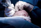 FUE Hair Transplant Istanbul: Advanced Hair Restoration in a Global Medical Hub