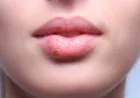 Lip Cancer: Symptoms and Causes