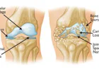 What Is the Difference Between Osteoarthritis and Arthritis?