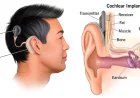 Facts You Must Know About Cochlear Implants