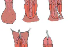 Hypospadias Repair Time and Recovery