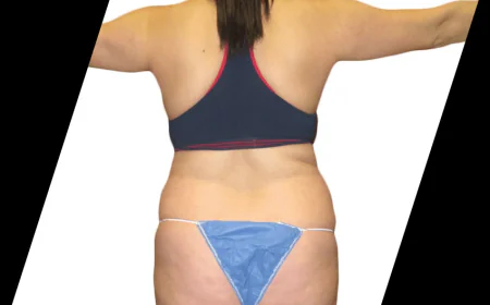 Why Should You Choose Smart Lipo Laser Houston for Fat Reduction?