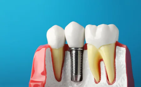 Missing Teeth? Here's Why Dental Implants Could Be the Perfect Solution