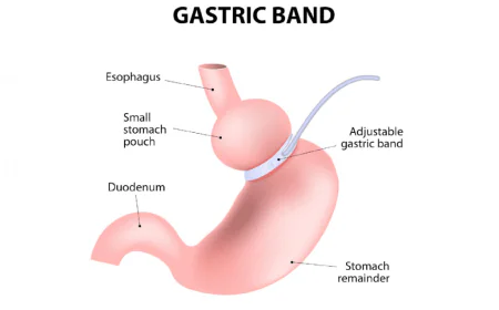 How to Choose the Right Surgeon for Gastric Banding