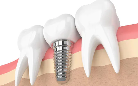 Before Comparing Dental Implant Quotes, Read This