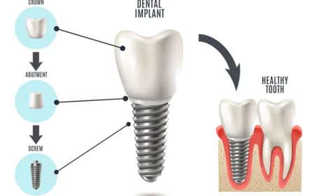 Dental Implants: A Long-Term Solution to Restore Oral Health and Confidence
