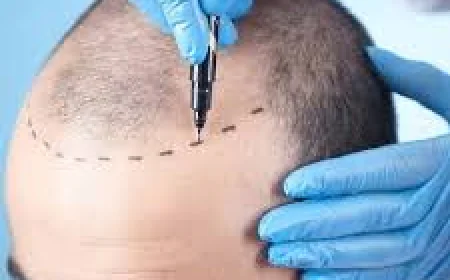 Hair Transplant in Dubai for Receding Hairlines: A Comprehensive Guide