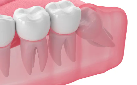 Why Delaying Tooth Removal Can Affect Your Oral Health