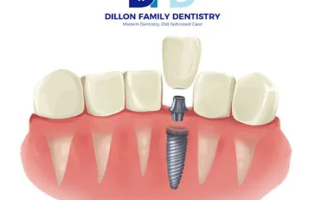 Dental Implants in Haverford, PA | Main Line Implant Care